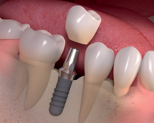 implantati-zubar-srdic-banja-luka-stomatologija